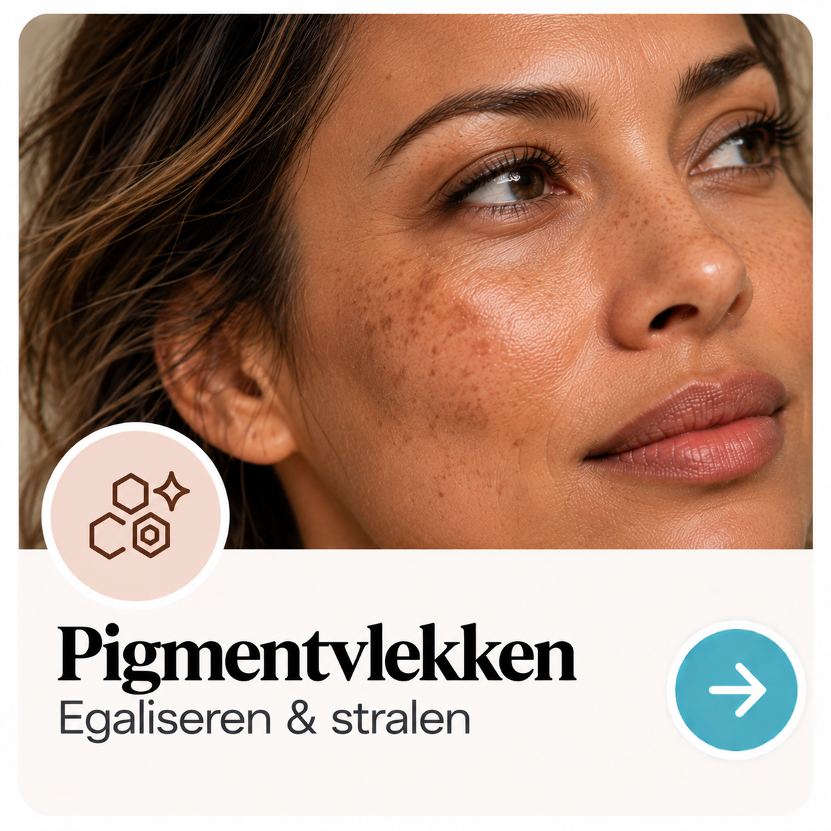 Pigmentvlekken